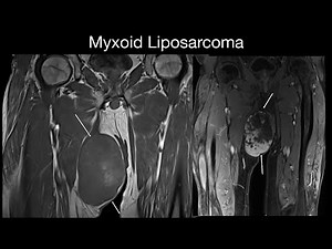 Myxoid Liposarcoma
