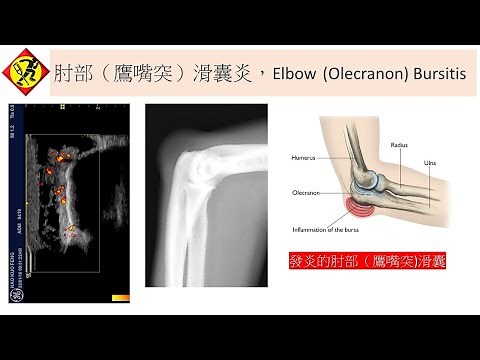 肘部（鷹嘴突）滑囊炎, Elbow (Olecranon) Bursitis