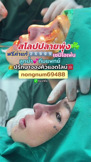 เสริมจมูกเทคนิค 𝑭𝒖𝒍𝒍 𝑶𝒑𝒕𝒊𝒐𝒏 เนื้อเยื้อX3 โปรโมชั่นราคา 25,999 จองโปรโมชั่น ฟรีค่าแก้ 999 ———————💕——————— เก็บสิทธิ์ได้6เดือน *แถมเนื้อเยื่อเทียม1ชั้น 🔅สิ่งที่คนไข้จะได้รับในโปรนี้🔅 ✅ซิลิโคนพรีเมี่ยมเคโอซาน ✅เทคนิคเซมิโอเพ่น ✅เทคนิคเย็บอินเตอร์โดม ✅เทคนิคตอกฐานกระดูก(แก้ปัญหาเบี้ยวเอียงได้ดี) ✅เทคนิคยืดผนังกั้น ✅เทคนิคตะไบฐานกระดูก ✅เทคนิครองปลายเนื้อเยื่อx3 -เทคนิครองปลายเนื้อเยื่อเทียม2ชั้น - เทคนิครองปลายเนื้อเยื่อผังผืด {เฉพาะเคสแก้} ✅เทคนิคตะไบฮัมพ์ พื้นฐาน ✅เทคนิคการเย็บแผล แบบ