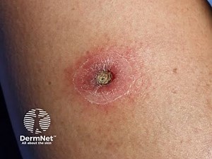 Ecthyma; deep, ulcerative bacterial skin infection that penetrates into dermis