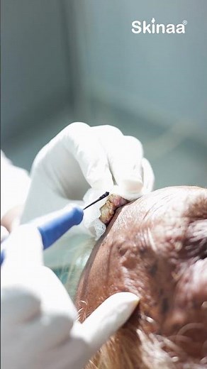 Giant Wart Removal | Safe & Expert Treatment at Skinaa Clinic Jaipur #moleremoval #dermatologist