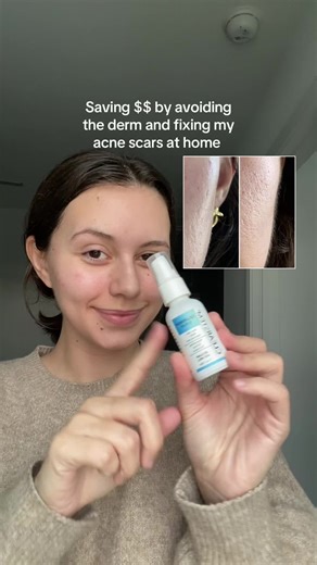 Fix Acne Scars at Home for Smooth Skin