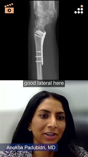 Observing Delayed Femoral Shaft Union With Robust Callus Formation