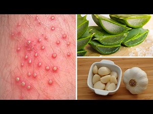7 Powerful Home Remedies to Get Rid of Folliculitis