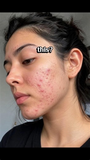 DIY Toner for Pimples & Acne | Natural Homemade Acne Toner for Clear Skin #skincare #acne #pimple