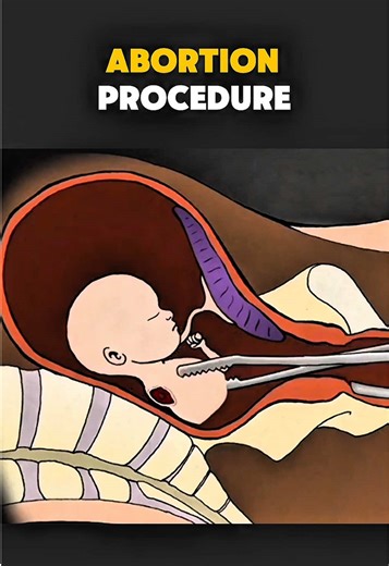 Abortion Procedure (3D animation) #abortion #WomensHealth #abortionprocedures #medicalanimation #healthawarenes