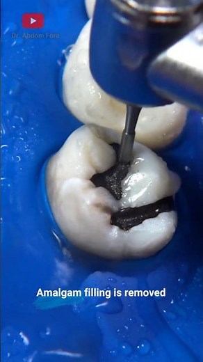 Amalgam filling removal #satisfying #shorts #dentist