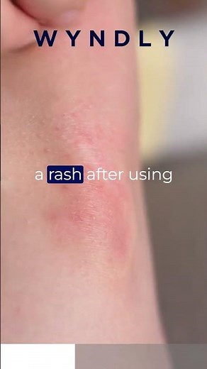 Can perfumes give you a rash? #perfumes #perfume #allergy #allergies #healthadvice #healthtips