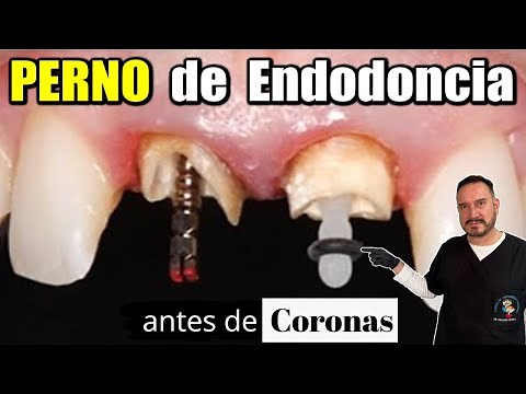 ENDOPE (ENDODONTIC POST) / BOLT FOR CROWN IN DENTAL PROSTHESIS