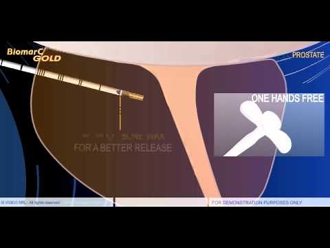 PROSTATE FIDUCIAL MARKER