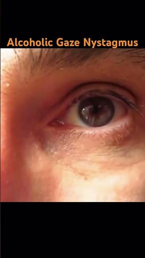 Alcoholic Gaze Nystagmus #neurology #opthalmology #alcoholism