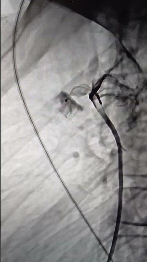 Placing an occluder to close a patent ductus arteriosus (PDA)