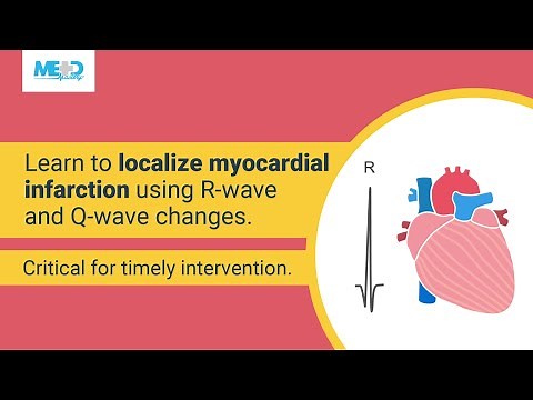 How to localize myocardial infarction based on R-Wave shrinkage and Q-wave development