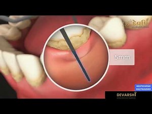 SCALING AND ROOT PLANING / PLAQUE CALCULUS ACCUMULATION ON ROOT