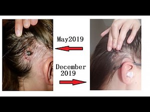 Six Months Later: BAHA Surgery Update and Thoughts (2019)