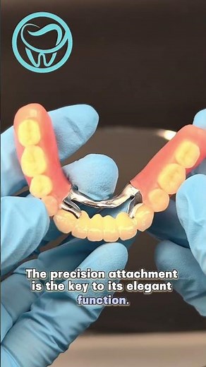 Precision Attachment Prosthesis. #dentallab #dentist #dentalprosthesis #dentures #attachment