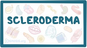 Scleroderma: Video, Causes, & Meaning | Osmosis