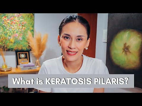 What is Keratosis Pilaris and how to Treat it? | Dr Gaile Robredo-Vitas