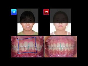 Solving Skeletal Class II with Deep Bite and 5mm OJ｜【Chris Chang Ortho】CC778