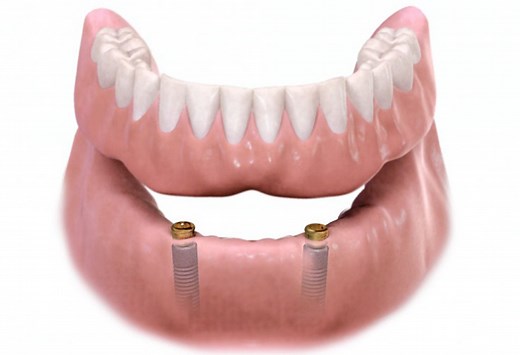 The Pro's And Con's Of Removable Overdentures | The Dental Lounge
