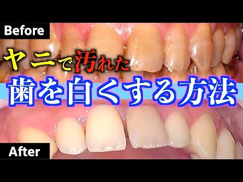 【超簡単】たばこのヤニ・ステインで黄ばんだ歯を白くする方法