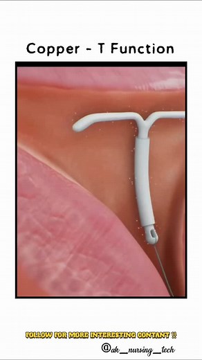 ᴀɪɪᴍꜱ || ɴᴜʀꜱɪɴɢ || ɴᴇᴇᴛ on Instagram: "Copper-T functions ꜰᴏʟʟᴏᴡ -@ak_nursing_tech 𝐀 𝐃𝐑𝐄𝐀𝐌 𝐖𝐈𝐓𝐇𝐎𝐔𝐓 𝐀𝐂𝐓𝐈𝐎𝐍 𝐈𝐒 𝐉𝐔𝐒𝐓 𝐀 𝐖𝐈𝐒𝐇❤️💯 ✍🏻 ADMIN = @anilchoudhary2000 ✍🏻 INSTAGRAM = @ak_nursing_tech ✍🏻 YOU TUBE = AK EDUCATION HUB ONLINE ✍🏻 TELEGRAM = Ak Nursing Tech 🅽🅾🆃🅴🆂 || 🆃🅴🆂🆃 🆂🅴🆁🅸🅴🆂 || 🅲🅻🅰🆂🆂🅴🆂 🗂️ BSC NURSING | GNM | ANM 🗂️ NORCET AIIMS || ALL NURSING EXAM 🗂️ ALL ENTRANCE EXAM 🗂️ MSC NURSING HASHTAGS = #ak_nursing_tech #aknursingtech #anilchoud