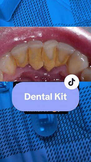 Elimina el sarro en minutos con este kit dental
