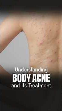 Body Acne Treatment - What to Use and What to Avoid