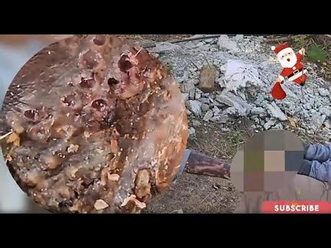 JIGGER REMOVAL - Extreme Jigger Nest – Crawling Under Skin! #DQ2577