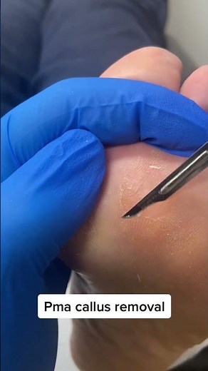 Dive into the world of podiatry, as Australia's finest tackles a Forefoot PMA callus.