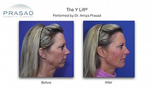 Y Lift vs. Liquid Facelift: What Makes Them Different?
