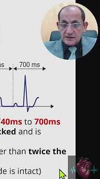 SA EXIT BLOCK ECG DIAGNOSIS (25)