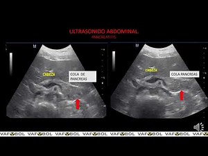 ECOGRAFIA PANCREAS