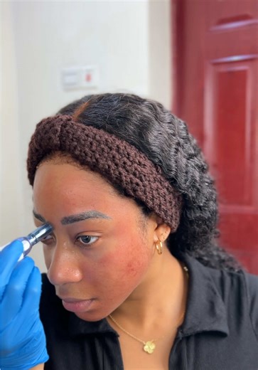 This is my second favourite procedure to do on my skin 🥰🥰