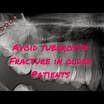 Upper Wisdom Tooth Extraction in an Older Patient