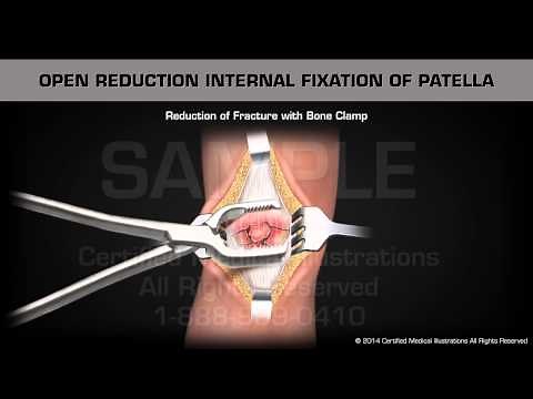 Open Reduction Internal Fixation of Patella