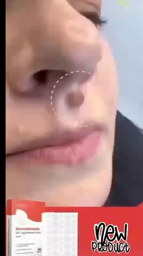 Say goodbye to skin tags & moles — painlessly and naturally!  Get flawless, glowing skin No pain. No scars. Just results you’ll love   Limited Stock – Shop Now https://ynt-stores.myshopify.com/products/derma-smooth-skin-tag-removal-patch-72-patches?fbclid=fbclid | YNT | Facebook