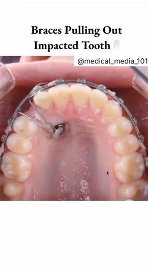 braces pulling Out impacted Tooth #doctor