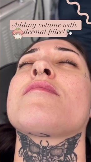 Adding Volume with Dermal Filler