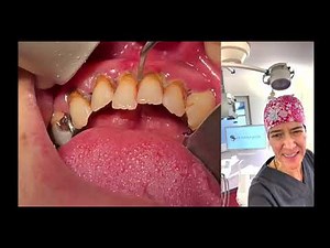 MASSIV Zahnstein entfernen