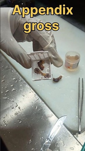 appendix gross pathology videos| #histopathology #histomuseum #cervicaltreatment #appendicitis #lab
