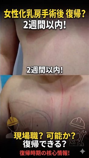 【女性化乳房】脂肪1,500cc除去！術後3日でデスクワーク・帰国が可能なスピード回復