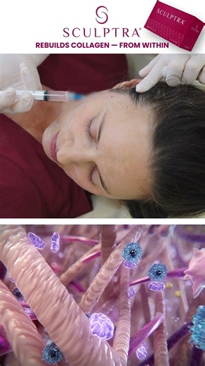 Sculptra Before & After | Collagen-Stimulating Injectable Explained #SculptraDubai #CollagenBoost
