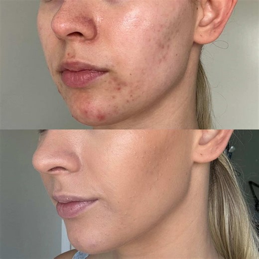 Mineral Powder Foundation for Sensitive Skin