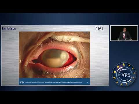 TASS and Endophthalmitis