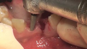 SuperGeePs (R) presents "Socket-Shielded Dental Implants- Fad or Future?"
