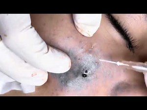 Extreme Acne & Scab Removal |#acne #pimple #blackhead #comfortable #tiktok