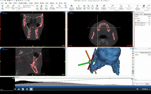 口腔生物力学分析（上）-牙齿建模和有限元分析讲解
