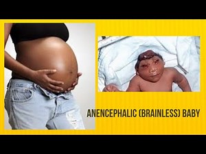 what is anencephaly (headless/brainless) fetus?