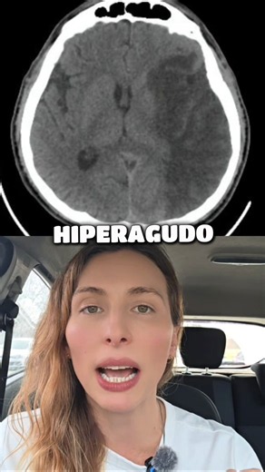ACV isquémico en #tomografia caso completo en el canal #radiologia #medicina